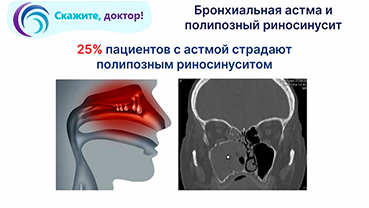 Основные методы лечения бронхиальной астмы